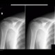 Humeroscapular periarthritis: X-ray - Plain radiograph